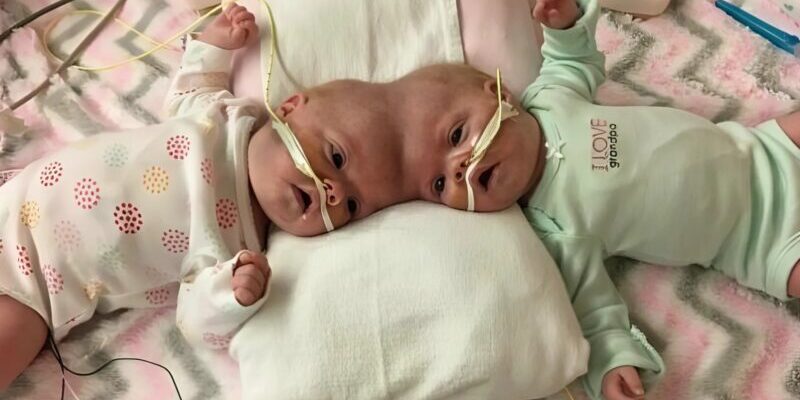 Sisters Were Born With One Skull, But Doctors Separated Them: Here’s What They Look Like Today