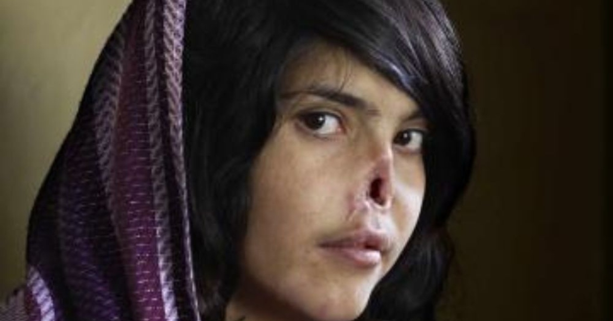 They Left Her to Die at 18!: See What She Looked Like Before the Tragedy That Changed Her Life!