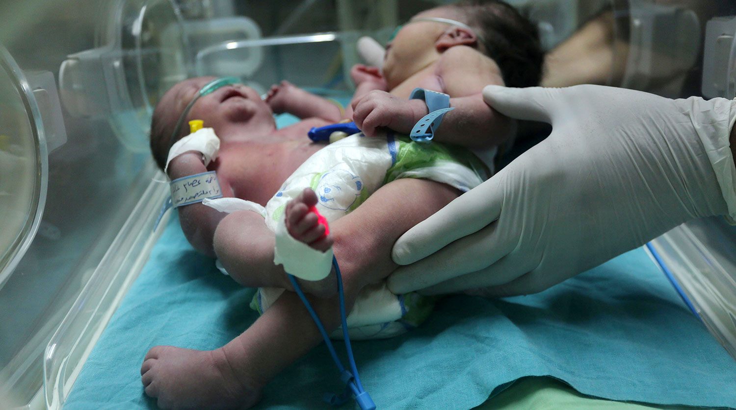 That’s Miracle! Born Conjoined at the Head, These Twin Sisters Faced a Dangerous Surgery — What They Look Like 9 Years Later Will Break Your Heart
