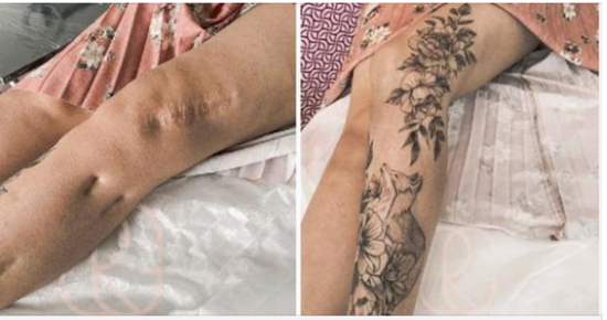 Tattoos that help turn your scars into something beautiful