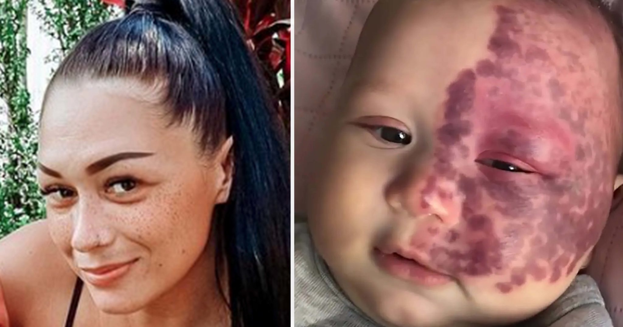 Mum labeled a “monster” for lasering port-wine stain birthmark on her baby’s face after birth