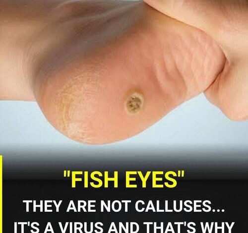 Plantar warts on the feet: what they are and why they shouldn’t be mistaken for a regular callus