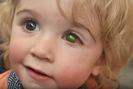 Toddler Goes Blind After a Simple Kiss Turns into a Tragic Incident