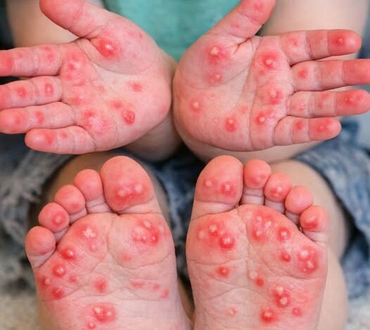 My toddler woke up with these angry red spots on his palms and soles. He’s refusing to walk. Docs are fully booked! Help needed.