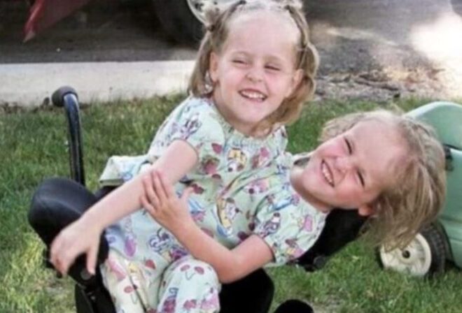 Search results for: Siamese twins separated at age 4 Now both sisters are 20 years old and this is what they look like