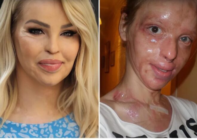 Acid attack survivor reveals her incredible transformation after 16 years of struggle.