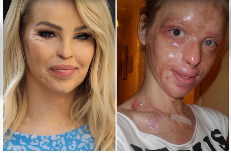 Acid attack survivor reveals her incredible transformation after 16 years of struggle.