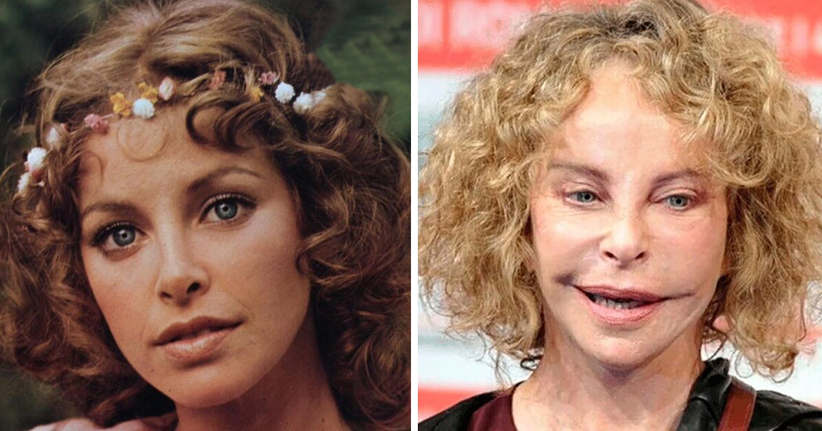 When the surgeon overdid it: 9 stars that are almost impossible to recognize after plastic surgery