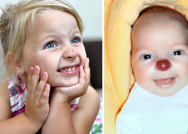 Nine years ago, a little girl named Connie was born with a distinctive facial feature—a bright red birthmark on her nose, often called a “clown nose.” Have a look at her present appearance and the way she lives…