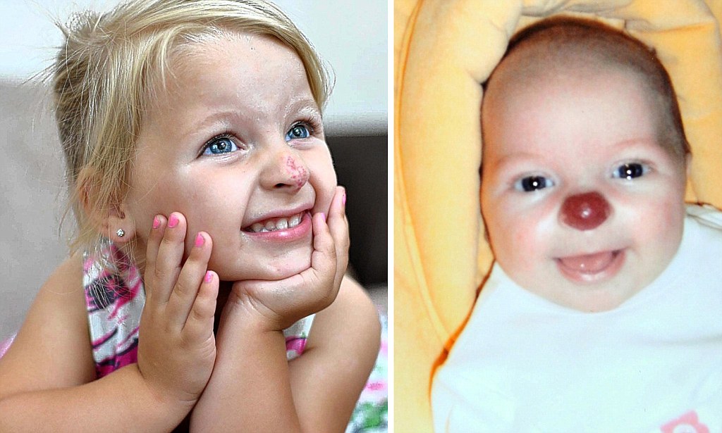 Nine years ago, a little girl named Connie was born with a distinctive facial feature—a bright red birthmark on her nose, often called a “clown nose.” Have a look at her present appearance and the way she lives…