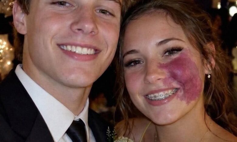 Only One Boy Asked Me to Prom Because No One Else Wanted to Due to the Birthmark on My Face – Everyone Laughed Until an Officer Walked Into the H