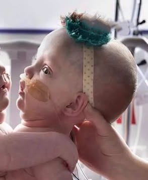 These Conjoined Sisters Were Born Fused at the Chest and Stomach